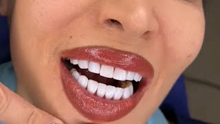 Dentist Teeth Makeover closeups [upl. by Sayre]