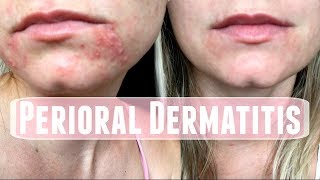 Perioral Dermatitis How I treated it [upl. by Fey]