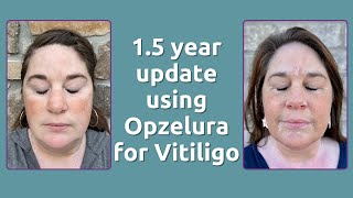 15 year update using Opzelura for Vitiligo amp Phototherapy [upl. by Annej]