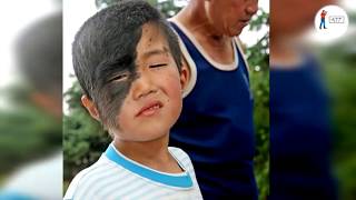 Top 10 Rarest Birthmarks You Have Ever Seen  AllTimeTop [upl. by Gnirps315]