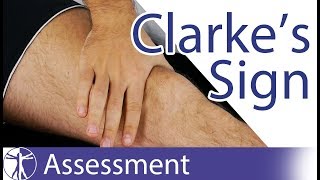 Clarkes Sign  Patellar Grind Test  Patellofemoral Pain  Chondromalacia Patellae [upl. by Eixel]