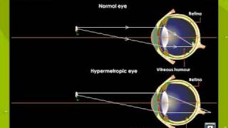 Hypermetropia or Hyperopia [upl. by Caundra]