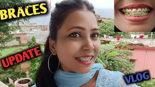 My Journey With Braces 😊 My Braces Update 7th Months ND Family Vlogs [upl. by Odnama613]