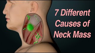 Adult Neck Mass 7 Different Causes Based on Location [upl. by Yrtnahc]