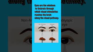 Amblyopia youtubeshorts vision video viralshorts [upl. by Nahseez]