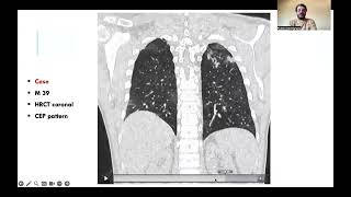 When to diagnose Chronic eosinophilic pneumonia in HRCT [upl. by Eadrahs]