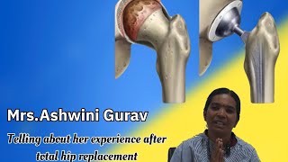 Dysplastic hip patient testimonial after hip replacement DrJaydeep Patil [upl. by Graaf]