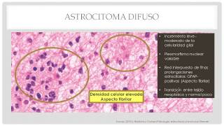 Astrocitomas Patología Morfológica y Funcional IV [upl. by Snowman940]