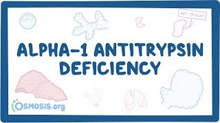 Alpha1 Antitrypsin Deficiency  causes symptoms diagnosis treatment pathology [upl. by Aylsworth]