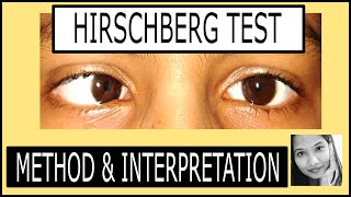 Hirschberg Test Explained Squint simplified for medical students [upl. by Ahseuqal912]