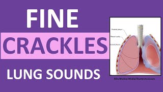 Crackles Fine Lung Sounds  Crackles and Rales Breath Sounds Abnormal [upl. by Hsara]