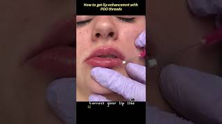 Lip augmentation procedure [upl. by Ettesoj]