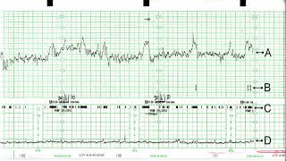 CTG in Practice Part 2 [upl. by Lenneuq861]