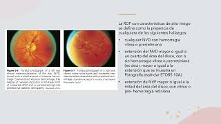 RETINOPATIA DIABETICA Y COREORETINOPATIA SEROSA CENTRAL [upl. by Eadahc]