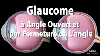 Pathologie du Glaucome Animation [upl. by Denby687]