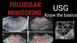 Follicular monitoring USG  The basics [upl. by Tecla]