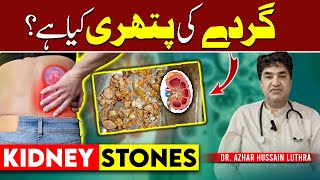 Is Your Lifestyle Causing Kidney Stones Find Out NOW [upl. by Remmer]