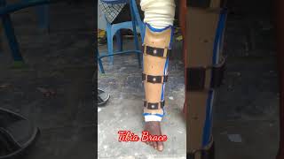 Tibia Brace [upl. by Lux]