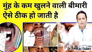 मुन्ह कम खुलने इलाज  Oral submucous fibrosis Causes and Treatment EXPERT ADVICE [upl. by Neenej]