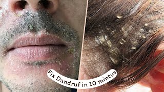 Dandruff treatment at home  khushki khatam karne ka tarika  khushki ka ilaj quickly [upl. by Anerroc]