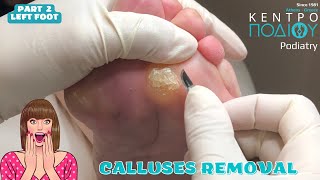 Calluses Removal KentroPodiou feet κεντροποδιου foot podologos podiatrist corn footcare [upl. by Jeavons]