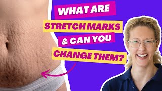 Can I change the appearance of my stretch marks [upl. by Llecram609]