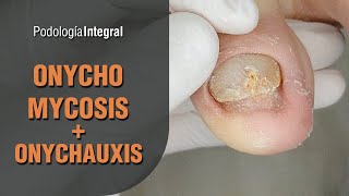 Onychomycosis  Onychauxis podology asmr [upl. by Arabelle836]