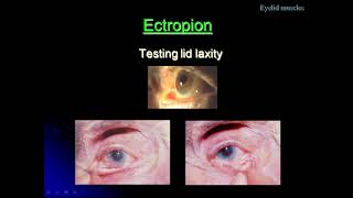 A Class On Ectropion By Dr VivekanandDept Of Ophthalmology [upl. by Ardnauqal916]