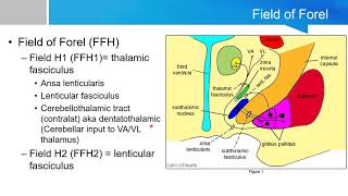 Neurosurgery written board crash course  basal ganglia part 2 [upl. by Karalynn]