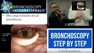 Bronchoscopy Step by Step Walkthrough 16 [upl. by Leik]