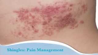 How to treat shingles [upl. by Inahs]