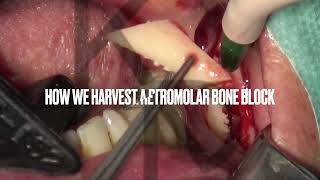 How we harvest a retromolar bone block with the Microsaw in only 1’34’’ [upl. by Licec]