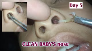 CLEAN BABYS nose day 5 [upl. by Idnyl590]