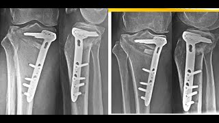 Ilizarov Case Discussion December 2021 [upl. by Tito]