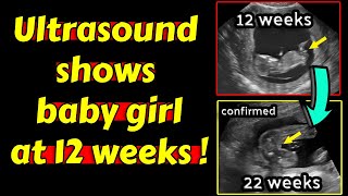 Ultrasound shows baby girl at 12 weeks pregnancy [upl. by Ruhtracm]