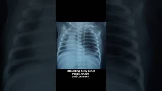 Newborn Xray l Interesting Xray seriespause review and comment nicu [upl. by Suoirred]