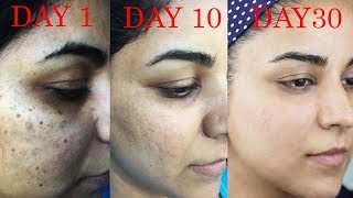 How I Got Rid of Dark Scars Hyperpigmentation PimplesAcne [upl. by Siuqramed]