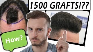 Matt Reacts to an Amazing Hair Transplant Result 1500 Grafts [upl. by Maretz]