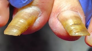 Two Very Long Toenails Helping The Elderly With Pedicure【Xue Yidao】 [upl. by Killoran]