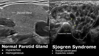 Salivary Glands Ultrasound Normal Vs Abnormal Images  Parotid Submandibular amp Sublingual Gland USG [upl. by Jacoby]