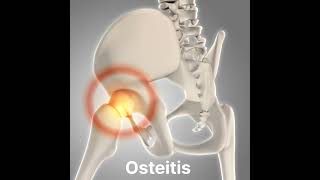 Osteitis inflammation of boneshorts [upl. by Notsehc]