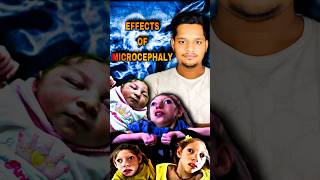 What is Microcephaly  Effects of Microcephaly  microcephaly india shorts facts ytshortsindia [upl. by Naga]