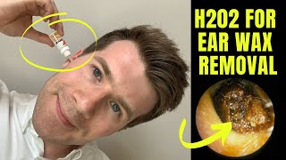 How to remove EAR WAX at home using HYDROGEN PEROXIDE H202 solution  Doctor ODonovan explains [upl. by Moyra]