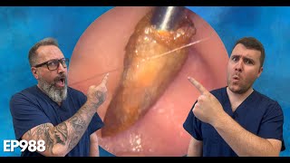 🔥 EARWAX PLUG amp SKIN REMOVAL FROM EAR EAR CLEANING  EP988 [upl. by Keating]