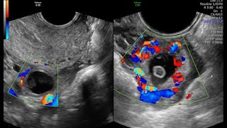 CORPUS LUTEUM VS ECTOPIC PREGNANCY [upl. by Clarette196]