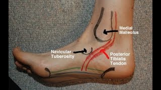 Posterior Tibial Tendinitis Evaluation with Paul Marquis PT [upl. by Gersham]