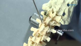 Pedicle Screw Fixation CORE Spinal System [upl. by Ahsoet]