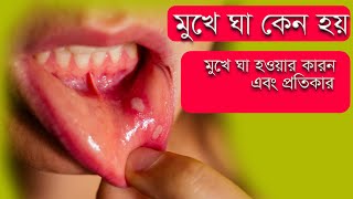 মুখের ঘা কেন হয় এবং প্রতিকার  Mukher Gha  Mukhe Gha Hole Koronio  Oral Ulcer Treatment [upl. by Rickert]