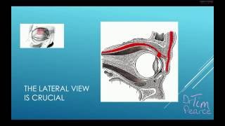 Eyelid Ptosis From Botulinum Toxins  Understanding The Crucial Anatomy [upl. by Derinna110]