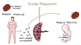 Understanding Rhesus Status and AntiD in Pregnancy [upl. by Averell]